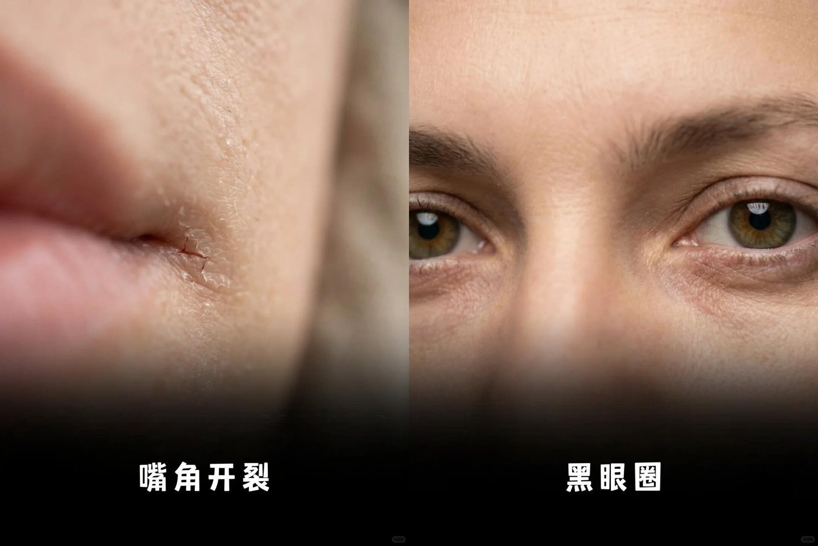 嘴角及眼周参考图：原因多样，不能单独诊断